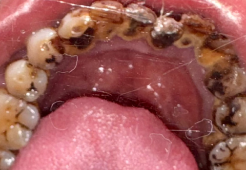 Lấy cao răng để làm gì? Lấy cao răng có đau không?